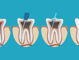 Эндодонтия и эндодонтическое лечение зубов