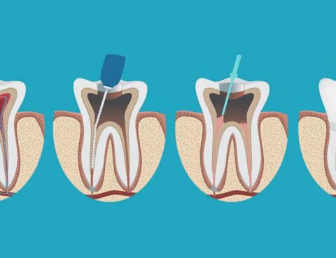Эндодонтия и эндодонтическое лечение зубов